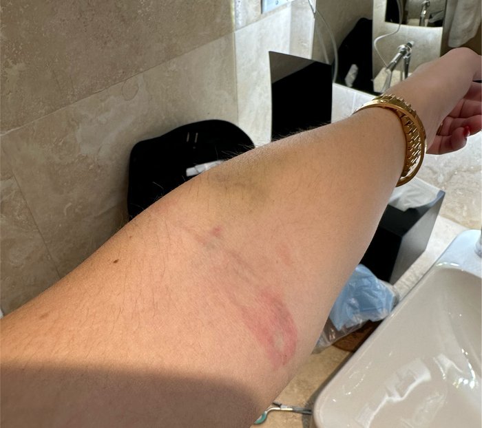 Skin reaction from a latex-free bandaid worn for about 30 seconds.