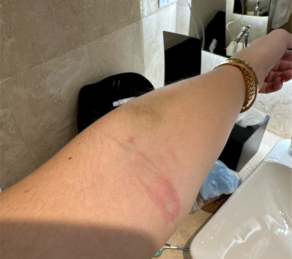 Skin reaction from a latex-free bandaid worn for about 30 seconds.