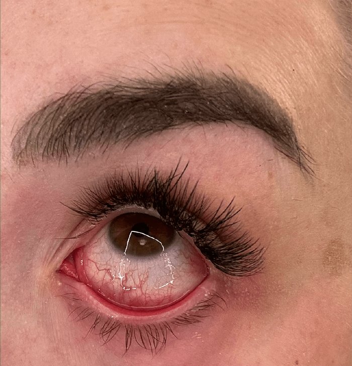 Bloodshot eye from mold exposure.