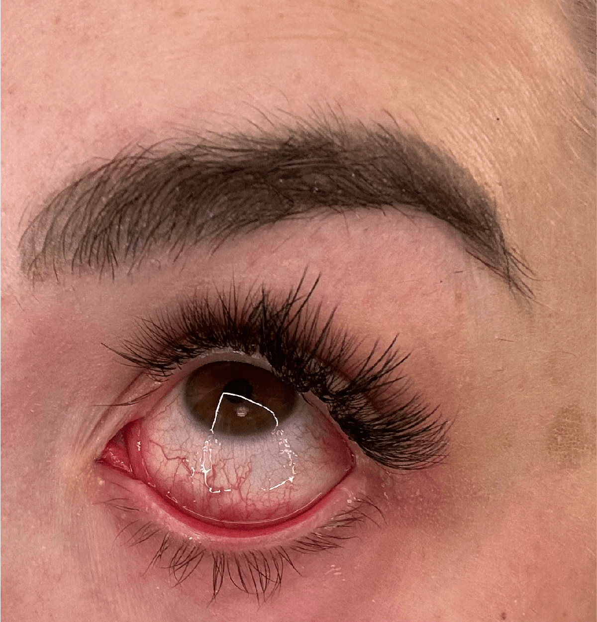 Bloodshot eye, a symptom of mold exposure.