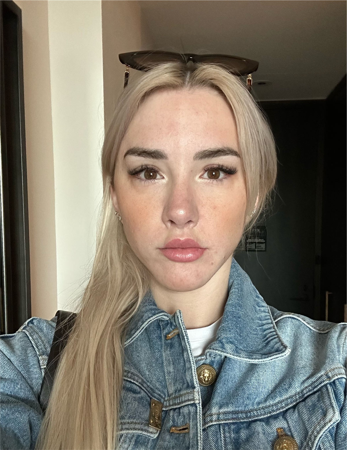 Mikhaila's face swollen from mold exposure.